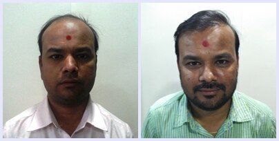 Providing both methods of hair transplantaion....FUE and FUT