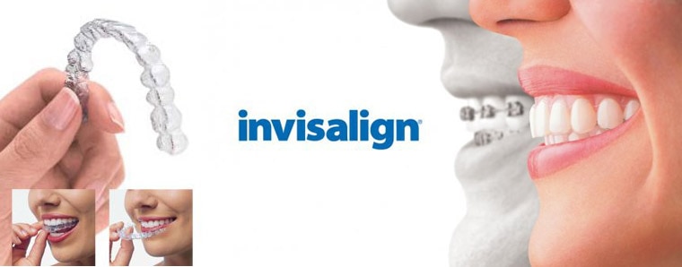 Invisalign Clear Braces is a great tool to align, fix gaps, and correct forwardly or irregularly placed teeth. Easy to maintain your teeth and also be aesthetically pleasing during Orhodontic treatment boosting confidence in smiling. Excellent for correction of teeth problems of highly placed marketing professionals, cabin crew, pilots, celebrities models and so on