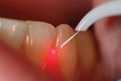 Laser assisted minor surgery