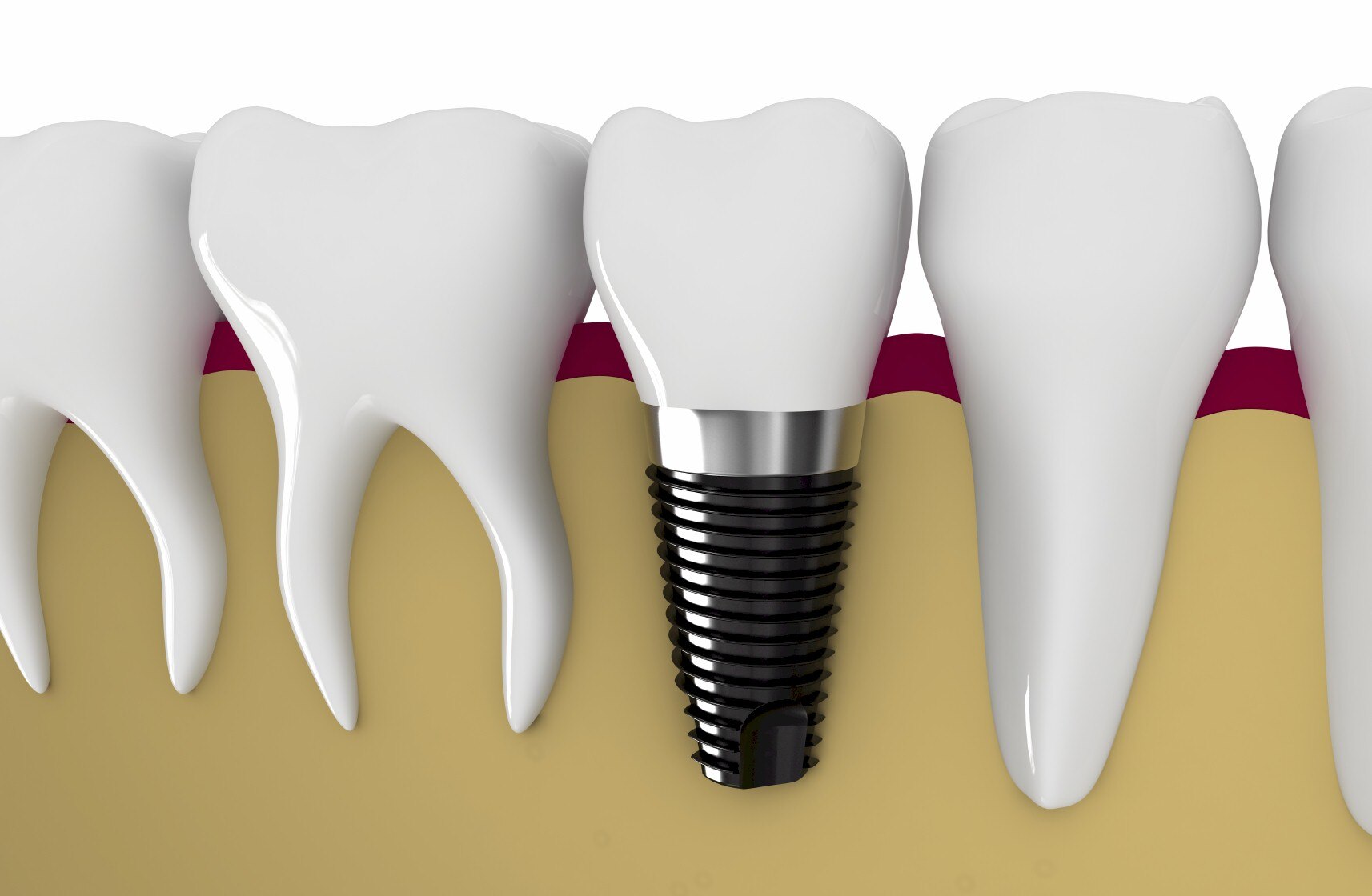 Dental Implant looks and functions like a natural tooth, it replaces a single tooth without sacrificing the health of neighboring teeth
