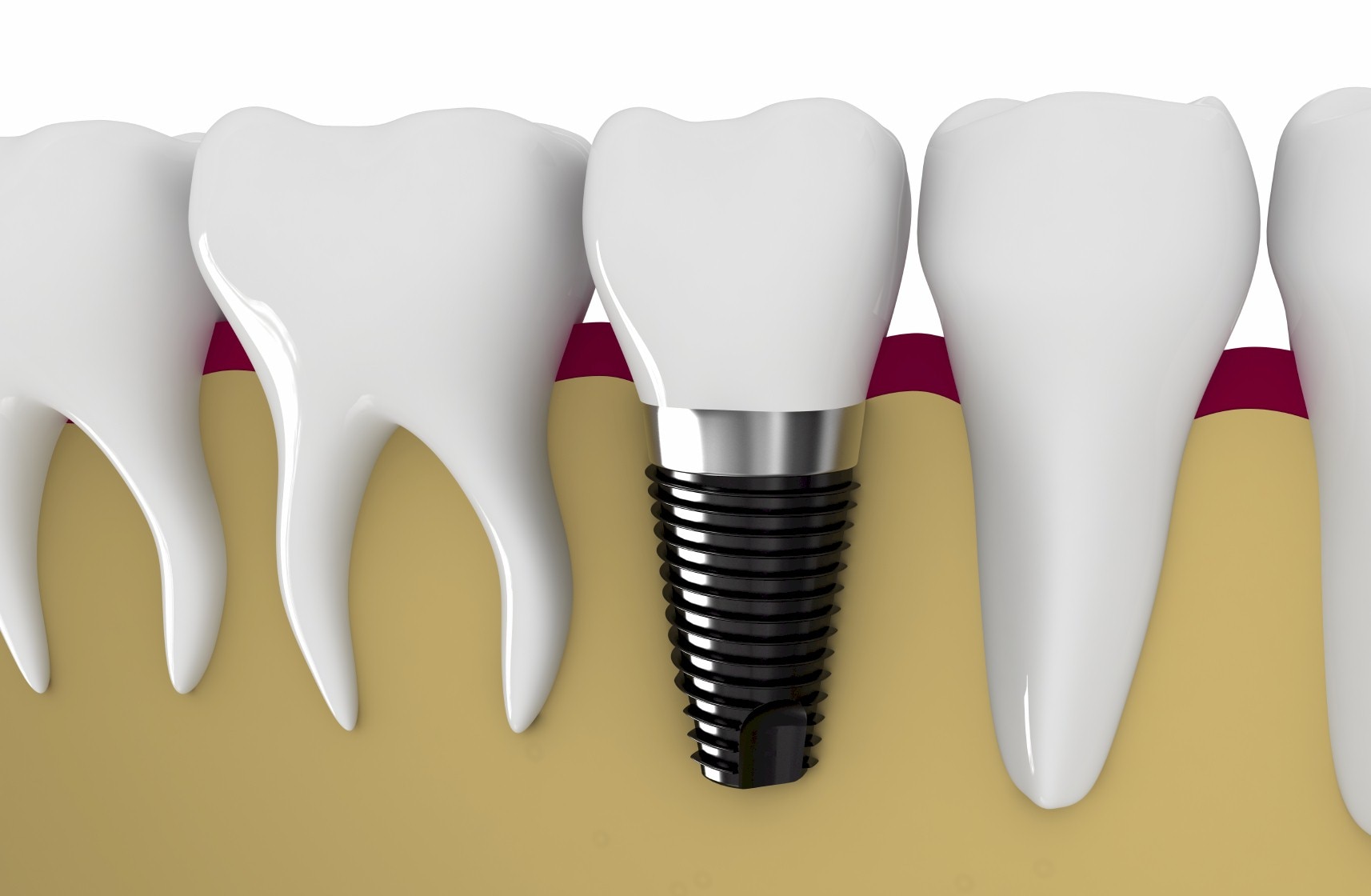 Dental Implant looks and functions like a natural tooth, it replaces a single tooth without sacrificing the health of neighboring teeth