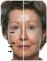 The Ultimate salon is specialized for age lock facial in ahmedabad ,the results which reflects around the Eyes ,Nasal Fold Around the Mouth Skin Firmness Smoother Texture Reduced Pore Size. Hurry Call for Appointment on 9327005240