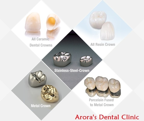 They have a metal base and layered by Porcelain/ Ceramic . Capping done at Arora's Dental Clinic will last very long as its done by a Prosthodontist - a specialist in Dental Crowns.