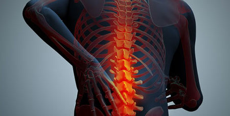 Each segment of the spine is crucial to the well being of the entire spinal column and cord since the strength of each portion is contingent upon the other vertebrae and discs to function properly. Through time, the spine may be subjected to constant stress, repetitive or high impact injuries, diseases, and arthritis. These conditions can cause pain, degeneration, and lack of function.
Ankylosing Spondylitis
Ankylosing Spondylitis (AS) is a form of progressive arthritis that creates chronic inflammation of the spine and sacroiliac joints, the two joints that connect the spine and the pelvis. Initially, inflammation occurs in the sacroiliac joints then progresses to the spine, causing stiffening and restricted movement. With long-term inflammation of the spinal joints (spondylitis), calcium deposits form in the ligaments around the invertebral discs that cushion the vertebrae and in the ligaments that hold the vertebrae together. As the ligaments calcify, movement and flexibility become severely impaired. The disease can progress to the point of fusing the vertebrae together which is known as “ankylosis.” As a result of AS, the vertebrae become brittle causing the spine to loose mobility and be receptive to fractures. AS is a systemic disease that not only affects the joints, spinal ligaments and bones, but also the body’s organs.
Arthritis
Inflammation of a joint, usually accompanied by pain, swelling, and stiffness, resulting from infection, trauma, degenerative changes, metabolic disturbances, or other causes.
Bulging Disc
Bulging discs are not uncommon, and frequently are displayed on MRIs as an abnormality for both young and older adults. Having a bulging disc is not necessarily a serious concern, and it may not even cause back pain. Bulging most likely happens as the body ages and degeneration of the intervertebral disc occurs. A bulging disk is formed when the soft, spongy center of the disk, the nucleus pulposus, pushes out and places pressure on the outer surrounding fibrous ligament, the annulus fibrosis that contains the center. Unlike a herniated disc, the bulging disc still contains the nucleus material.
Cervical Arthroplasty
In treating cervical disc degeneration, treatments are often limited to decompression, correction of deformity, or stabilization of the spine. With the exception of decompression, procedures such as these require fusion, which immobilizes the spinal segments that are fused. Cervical Arthroplasty is a break-through procedure which involves disc replacement, restoring range of motion and offering a significant treatment toward spinal pain.
Degenerative Disc Disease
Over time, the spine can be stressed with daily motion and minor injuries that eventually create wear and tear on the intervertebral discs causing them to degenerate. The discs are designed similar to shock absorbers to handle pressure and impact, as well as act as a cushion during the body’s movement to keep the spine flexible. Their role is vital to preserving the vertebrae, as bones cannot sustain repeated stress without becoming damaged.
In a healthy intervertebral disc, the soft, spongy center known as the nucleus pulposus contains a high level of water content allowing it to absorb stress. When excessive pressure or impact is incurred by the disc, the annulus (the tough outer ligament material that surrounds the nucleus and supports the vertebrae), is often the first portion of the disc to exhibit damage. Small tears in the ligament material are replaced with scar tissue as the body tries to heal itself. However, the scar tissue is not as strong as ligament and weakens the annulus. As the outer layer degenerates, the nucleus pulposus begins to loose water causing it to dry up.
Due to water loss, the disc looses its capability to absorb stress and act as a cushion for spinal flexibility. This situation creates added stress, and the damage cycle becomes repetitive further tearing the annulus and causing the nucleus to collapse. As the disc compresses, the space between the vertebrae above and below it narrow. As the area becomes constricted, the facet joint, located at the back of the spine, can move out of position rendering the joint less operable.
In addition to the lack of joint facilitation, bone spurs known as osteophytes may form around the disc space and the facet joint as the body’s response to impede excessive motion to the damaged area of the spine. The bone spurs can impair the spine if they grow into the spinal canal and press on the spinal cord and nerves. This condition is known as spinal stenosis.
Facet Disease
The Facet joints are the joint structures that connect the vertebrae to one another. The facet joint is like any other joint in your body – they have cartilage that line the joint, (this allows the bone to glide smoothly over one another) and a capsule surrounding the joint. The function of the facet joint is to provide support, stability, and mobility to the vertebrae (spine). Facet Disease occurs when there is degeneration of the facet joint.
Foraminal Stenosis
Foraminal stenosis is a narrowing of the spinal foramen, the hole through which passes a spinal nerve as it exits the spine (foramen basically just means “hole”). It is usually a form of degenerative spine disease which occurs slowly over time with wear and tear of the spinal column. Arthritic changes of the spine, including herniated discs and bulging discs, soft tissue swelling and bony growth can all impinge on the formal foramen and compress the nerve within.
Herniated Disc
Disk herniation is a rupture of fibrocartilagenous material (annulus fibrosis) that surrounds the intervertebral disk. This rupture involves the release of the disk’s center portion containing a gelatinous substance called the nucleus pulposus. Pressure from the vertebrae above and below may cause the nucleus pulposus to be forced outward, placing pressure on a spinal nerve and causing considerable pain and damage to the nerve. This condition most frequently occurs in the lumbar region and is also commonly called herniated nucleus pulposus, prolapsed disk, ruptured intervertebral disk, or slipped disk.
Pinched Nerve
A pinched nerve occurs when too much pressure is applied to a nerve by surrounding tissues — such as bones, cartilage, muscles or tendons. This pressure disrupts the nerve’s function, causing pain, tingling, numbness or weakness.
Spinal Stenosis
Spinal stenosis is any narrowing of the spinal canal that causes compression of the spinal nerve cord. Spinal stenosis causes pain and may cause loss of some body functions.
Sciatica
Sciatica refers to pain or discomfort associated with the sciatic nerve. This nerve runs from the lower part of the spinal cord, down the back of the leg, to the foot. Injury to or pressure on the sciatic nerve can cause the characteristic pain of sciatica: a sharp or burning pain that radiates from the lower back or hip, possibly following the path of the sciatic nerve to the foot.
Spondylosis
A degenerative disease of the spinal column, especially one leading to fusion and immobilization of the vertebral bones. Also considered arthritis of the spine.
Spinal Fractures
The spinal bones have great strength, but like other bones in the body, they can fracture under circumstances that involve too much pressure, trauma or disease. When a spinal bone fractures it is known as a vertebral compression fracture. These types of fractures occur most often in the thoracic (middle portion) of the spine in the lower vertebrae.
A normal bone can handle a great amount of pressure and with the spine’s flexibility it can bend to absorb stress, however if a bone weakens, the force becomes too great for the bone to sustain it. Intense pressure, physical injury or trauma can lead to minor or severe fractures. Trauma such as a fall, hard jump or impact from a car accident may stress the spine past its breaking point causing one or more of the vertebrae to crack or break apart.
Osteoporosis, a disease that thins the bones can also weaken the vertebrae until they are unable to withstand pressure causing them to collapse. Spinal compression fractures are the most common type of osteoporotic fractures, besides the hip and wrist bones. These vertebral fractures can permanently alter the shape and strength of the spine, especially in elderly women who are more susceptible after hormone loss to losing weight and having spinal deformity. The spine may appear like a humped back where the shoulders fall forward and the top of the back looks enlarged. This disorder is referred to as “kyphosis.” In severe cases of osteoporosis, simple movements such as bending forward can create a crush or compression fracture.
TRETMENT
IN AYURVEDA THERE ARE SEVARALSPECIFIC AND BROAD LINE OF TREATMENT FOR EACH DISC PROBLEM MOST COMMANLY WE USE TO CURE SPINE DISORDERS ARE:
1.VIRECHANA
2.MADHUYESTIKSHEERAPAKA BASTI (KALA BASTI)
3.KATI BASTI
4.GREEVA BASTI
5.PRUSTA BASTI
6.PATRA PINDA SWEDA
7.THULODUL & THUMBING
APART FROM ABOVE MENTIONED PANCHKARMA THERAPY PATIENTS SHOUD CONTINUE THE PRISCRIBED MEDICINES FOR MINIMUM OF 3 MONTHS
For further details please contact : 23505777, 9341226614