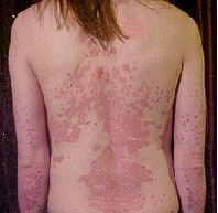 Psoriasis (from Greek meaning