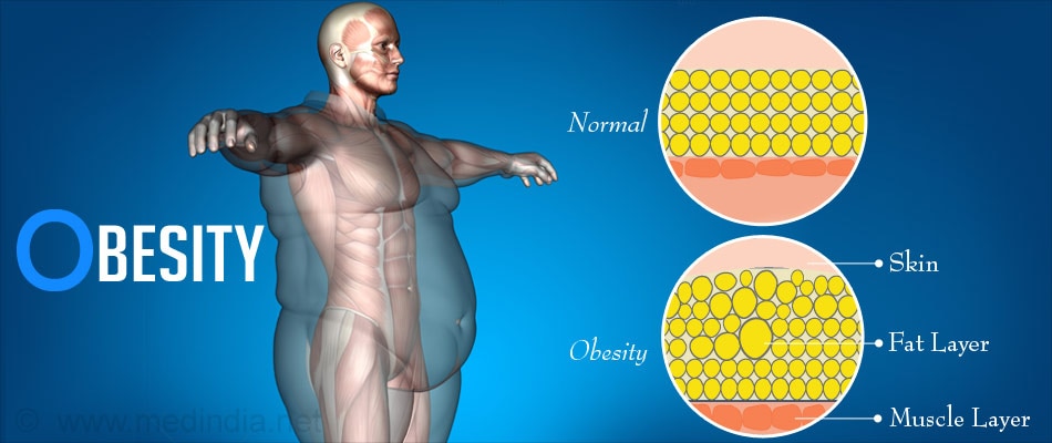 The Causes Of Obesity Are:
When a person consumes more calories than he burns then the excess calories get stored in the form of fat causing obesity.
Genetic Factors - Obesity tends to run in and their tendency to accumulate fat. Even the diet and lifestyle habits which are practiced in family also contribute to obesity.
Environment - A person’s eating habits and level of physical activities a person has also contribute for excess deposition of fat. When a person eats food containing more calories and has a sedentary work then the calories consumed are more than calories burnt. The excess amount calories are stored as fat.
Psychological Disturbances - There is a tendency over eat in response to negative emotions like boredom, sadness or anger. This leads to obesity.
Binge eating disorder.
Diseases and Conditions - like Cushing's syndrome, Depression, and certain neurological problems lead to overeating which in turn leads to accumulation of fat.
Medicines - such as steroids and antidepressants may cause weight gain.
Insulin stimulates LPL formation. The LPL breaks the circulating to free fatty acids which can enter the adipocyte. Insulin is also required for the transport of glucose, which is needed for conversion of free fatty acids to tryglycerides in adipocytes. The conversion of glucose to fatty acids is accomplished by insulin's activity on several enzymes.
CAUSES EXPLAINED IN AYURVEDA
The causes of obesity are very clearly explained in Ayurveda. The following reasons which are mentioned in Ayurveda increases the deposition of fat in one's body.
According to Ayurveda the causes of obesity are defined as
Avyayama : Lack of physical exercise.
Divaswapna : Sleeping in afternoon.
Shleshmala Ahara Vihara : The diet and life styles increase Kapha.
Madhura Annaha : Consuming.
Obesity - Accumulation of Fat
How Does Fat Accumulate Inside One's Body.? Adipose tissue is specialized connective tissue that functions as the major storage site for fat in the form of triglycerides.
There Are Two Different Types of Adipose Tissues, namely
White adipose tissue
Brown adipose tissue
Most Adipose Tissue is White. White Adipose Tissue Does Three Functions, namely
Heat insulation.
Mechanical cushion (adipose tissue also surrounds internal organs and provides protection for these organs).
A source of energy.
The adipose tissue which is directly below the skin (subcutaneous adipose tissue) specially acts as the heat insulator of the body. It conducts heat only one third compared to other tissues. The degree of insulation is dependent upon the thickness of this fat layer.
Lipogenesis
Lipogenesis is the deposition of fat. This process occurs in adipose tissue and in the liver.
Insulin, a hormone secreted by the cells of the pancreas, plays an important role in the lipogenic process. The net effect of insulin is to
Increase storage
Block mobilization and oxidation of fatty acids
Obesity Leads To The Following Health Complications
Type - 2 diabetes
Heart disease
High Blood pressure
Stroke
Few types of Cancers
Gall stones
Liver diseases
Osteoarthritis
Gout
Infertility
Irregular menstruation in women
According To Ayurveda An Obese Individual Is More Prone To The Following Health Disorders
Diabetes
Kidney related problems
Hepatitis
Low libido
Low energy levels
Skin problems
Fistula
Piles
Filariasis
OBESITY FOR AYURVEDA
Obesity - Maintain Your Waist Line And Reduce Obesity
FEW HANDY TIPS:
1)Start morning walk, slowly increase up to 1 hr 30 minutes.
2) Drink water, minimum 2.5L per day.
3) No sweets.
4) Start green tea or black lemon tea.
5) Avoid bakery food, oil fried food, ice cream and etc.
6) No rice or rice item at nights.
7) Use more green vegetable.
TREATMENT
VAMANA
VIRECHANA
LEKHANA BASTI
UDVARTANA
For further details please contact : 23505777, 9341226614