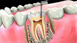 We at Dr Gupta's Dental Clinic want the best and the latest for our patients. Gone are the days when just to do a single root canal you had to make three to four visits to a dentist. With the latest endodontic equipment. That we use in our office not only is the root canal done in single sitting but is totally painless. Our patients are so amazed sometimes that they just can't believe that the treatment is over. Root Canal, is the prevention, diagnosis and treatment of disorders of the dental pulp. The pulp is made up of nerves, blood vessels, and connective tissue, which are important in tooth development.
How do you know if you have an inflamed/infected tooth nerve?
Some signs are heat and cold sensitivity, swelling and pain, or a bad taste in your mouth. Or, you may experience no symptoms at all, and not realize that you have a dental problem until your Dentist discovers this before you get symptoms.
How does a nerve get inflamed/infected in the root canal?
Deep cavities allow germs to get into the pulp chamber. These germs cause infection, and the pulp dies. The pus from the infection eventually builds up at the root tip and makes a hole in the bone. This is called an abscess. A blow to a tooth may also cause the pulp to die and then become infected. An infected tooth will never heal on its own, and as it gets worse, it will continue to be a source of infection that weakens your immune system. This can affect your entire body. This damage to the bone and the swelling inside the bone can also be excruciatingly painful, and even life-threatening.
THE PROCEDURE
The dentist will examine the tooth and x-rays before numbing the area around the affected tooth. They will then drill through to the pulp area, either through the top or the back of the tooth. Very small instruments and an antiseptic solution will be used to clean the pulp and root canals and a space is shaped for a filling. When the space has been cleaned and shaped, the dentist will fill the root canal with a bio compatible material. This is usually a flexible plastic material called