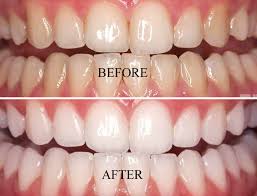 We are proud of our practice, where we use the most modern technologies. Your dentist or hygienist will use a 'scale and polish' when your teeth require a thorough clean to remove all traces of plaque and tartar. Scaling is used to remove the hard tartar on your teeth, which cannot be removed by simply brushing your teeth.