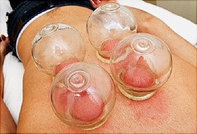 Cupping therapy is an ancient form of alternative medicine in which a therapist puts special cups on your skin for a few minutes to create suction. People get it for many purposes, including to help with pain, inflammation, blood flow, relaxation and well-being, and as a type of deep-tissue massage.
The cups may be made of:
Glass
Bamboo
Earthenware
Silicone