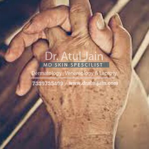 Age spot is another type of skin ailment that develops in both men and women who have too much exposure in the Sun. Aging is also the sign of the development of age spots. Dr. Atul Jain is a skin specialist who believes that skin is the most sensitive part of the body.
He treats the age spots, considering the severity and the age of the spots. He suggests medicines, bleach creams, lotions and chemical peel to treat the age spots. Other than this, he strongly proposes Laser therapy, but only after the consultation of the skin specialist.