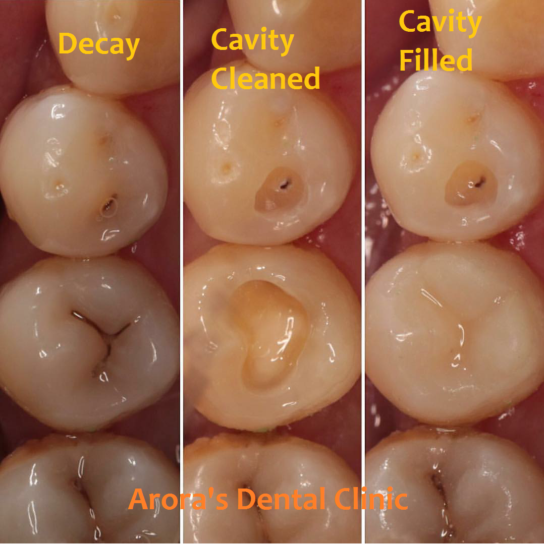 Cavity on a tooth is cleaned by special diamond points and the area is filled by shade matched nano filled composite which are activated by a special light. The fillings done at Arora's Dental Clinic last forever.