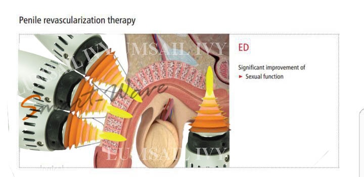 Low Intensity Shock Wave Therapy for Erectile Dysfunction and Premature Ejaculation is Consider First line of Treatment at US, UK. It help in Penile Revascularization. It is pain free,short treatment with no reported side effects.Treatment Protocol: Frequency:5-10 Hz, Energy :10 mj,Number of shots:500-800 per time, Number of Treatment-4-8 Treatment frequency-1-2 per week and can be Repeated after 6 moth- 1 year if needed.
1 Session-3500
4 session-12000
8 session-20000