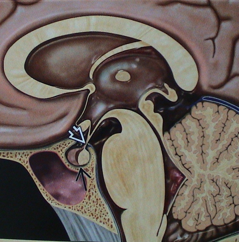 Pituitary Tumors - Surgery for tumors arising from the pituitary gland .
the pituitary gland lies at the base of the brain in a small bony impression called as the sella. The pituitary gland is responsible for the overall control of hormones regulating the various bodily functions ( thyroid, adrenals, gonads-ovaries & testes). Tumors arising from the pituitary gland can present with hormonal disturbances, eyesight problems (reduction in visual field)and other non-specific problems like headaches or giddiness. All these problems can arise slowly or may manifest suddenly due to bleeding inside the pituitary gland( pituitary apoplexy).
Surgery is needed for tumors which are not responsive to medications or if the tumor is causing pressure on the optic nerves giving rise to visual problems.
Surgery for pituitary adenomas is most commonly performed through the nostril with an endoscope or microscope. Patients need hospital stay for 4-5 days approximately. close monitoring of hormones is required in the post operative period.