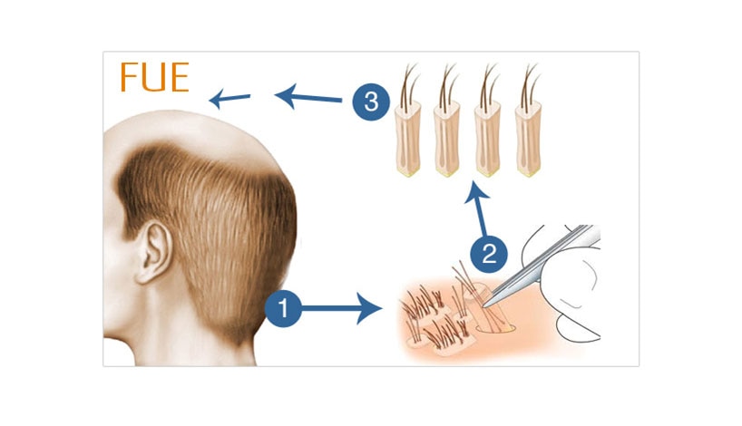 New Roots Cyclical Polytherapy
Beside hair loss we have measure to stop ongoing hair fall. The major cause of hair loss in today’s era is androgenic alopecia along with telogen effluvium.
We have advanced new roots cyclical poly therapy which includes combination of treatments to stop hair fall within very short period of time and also helps to stop miniaturization and increase density of hair on scalp.
It includes:
LLLHT
The laser hair restoration unit has helps to grow new hair naturally in places of miniaturizing scalp. It makes effective and affordable hair rejuvenation. It makes existing hair thicker, fuller and healthier. It uses combination of LASER & LED lights. It helps in early stages OF HAIR THINNING.
PRP Platelet rich plasma
Platelet rich plasma is blood plasma that is enriched with platelets. Its crucial function is to repair wide range of injuries and diseases in both soft and hard tissues. This is due to many growth factors present in platelets. PRP is a concentration derived from your own blood. It has lot of good growth factors that stimulate hair growth factors that stimulate hair growth when injected into the scalp. Not all PRP for hair loss is created equal. When it comes to stopping of hair loss concentration of 10 lack platelets / 1 ml is best. Achieving this concentration requires good technology compared to simple centrifuge. So we achieve PRP containing a concentration of platelets that is higher than your blood.
PRP > delivery in the area of hair loss > improvement in concentration of growth factors > development of stem cells in middle and base of hair follicle > thickening of hair follicle and robust body with an extended life cycle.
Oral medication
Depending upon deficiency detected in body the perfect medication is advised to avoid ongoing hair loss.
Local apllications
Along with other treatments this local application can’t be forgotten as it is very necessary to cure scalp diseases leading to hair fall.
PRP with hair transplant
Hair transplant can grow new hair in bald area but to stop hair loss of hair already on scalp PRP helps better. We offer free PRP treatment to our hair transplant patients.