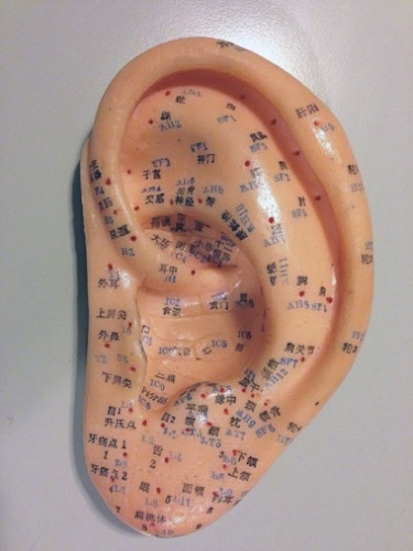 Acupuncture improves hearing for patients with hearing loss. Research published in the International Journal of Clinical and Experimental Medicine finds acupuncture effective for the treatment of nerve related deafness. This type of sensorineural deafness is hearing loss due to auditory nerve damage