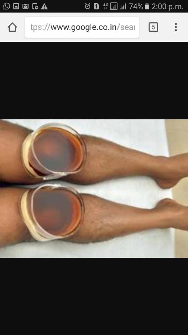 Janubasti(Ayurveda knee care therapy)----
It gives a magical relief from the pain & stiffness associated with knee pain.
Medicated oils are poured and pooled for a fixed duration of time in a compartment constructed around the knee joint .
Indications---
1.Knee pain
2. Osteoarthritis of knee joint.
3.Knee injuries(e.g.-ACL injury)
4. Torn meniscus
5. knee bursitis
6. Patients suggested for total knee replacement(TKR)