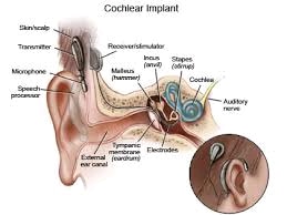 A cochlear implant (CI) is a surgically implanted electronic device that provides a sense of sound to a person who is profoundly deaf or severely hard of hearing in both ears; as of 2014 they had been used experimentally in some people who had acquired deafness in one ear after learning how to speak. Cochlear implants bypass the normal hearing process; they have a sound processor that resides on the outside of the skin (and generally worn behind the ear) which contains microphones, electronics, battery, and a coil which transmits a signal to the implant.