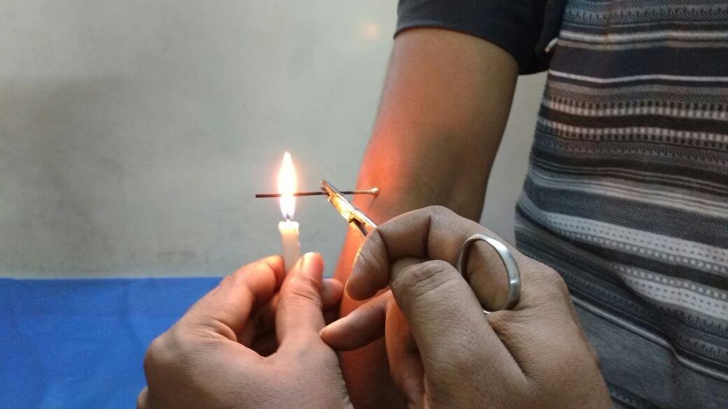 Diseases treated by agni karma do not recurrence and it can be used even in diseases which have not been successfully treated by drugs , kshara and shastrakarm(operations)
Indications---
1.Degenerative joint disorders
2.Arthritis
3.calcaneal spur(heel pain)
4.Achilles tendon , ankle pain
5. Sciatica
6.Low backache
7. Neckpain
8.Sports injury
9.Post fracture residual pain
10.Migraine
11.Frozen shoulder
12. Carpel tunnel syndrome
13. corn
14.warts
