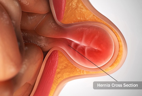 Surgery For hernia