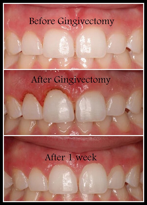 Gingivectomy Dr Sachdeva Dental Clinic Delhi, New Delhi