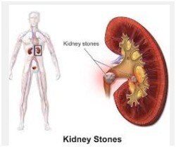 Kidney Stone Removal
