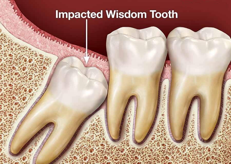 WISDOM TOOTH REMOVAL D Care Laser Dental Clinic, Chennai