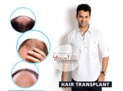 Hair transplant is a procedure that involves re-distribution of natural hair follicles. It is the best choice of treatment for MPB (male pattern baldness) when the baldness is stable. The healthy hair from back of head, beard and body are extracted and transferred to bald areas..
There are two major types of techniques for transplant:
FUT: It's a conventional method in which a strip from the donor area (located on the back of your head) is harvested, follicles are then separated under magnifying glasses and the area is then sutured.
FUE: In this technique, single hair graft is removed at a time using a specialized extraction machine. No suturing is required.
Hair-transplant now-a-days is very well accepted by many as a treatment option for baldness, and is well known to one and all. But what people lack in knowing is that not all clinics follow the same protocol and technique. Successful hair transplant depends mainly on the skill and experience of the doctor, the type and size of punches and implanters used during the procedure, the handling of the grafts, to name a few.
We at Yuva Coamoderm, offer latest technique of hair transplant done by experienced doctors that involves