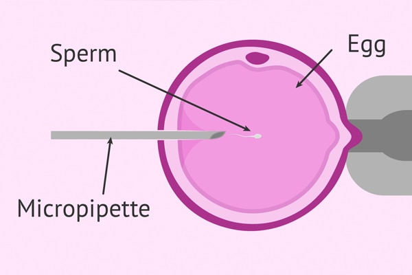 cytoplasmic sperm injection Cytoplasmic sperm injection