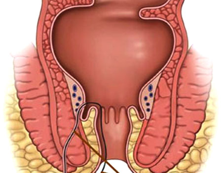 Laser Surgery For Fistula