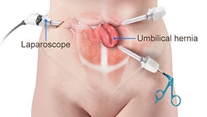 Laparascopic Surgery For Umbilical Hernia