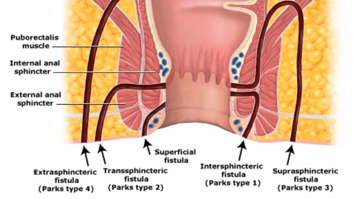 Anal Fistula Treatment