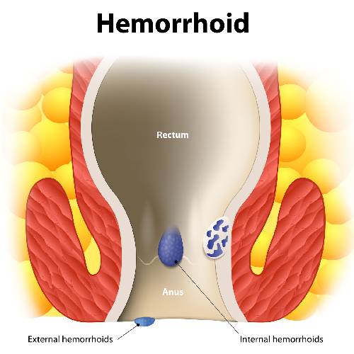 Laser Treatment Hemorrhoids /Piles