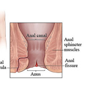 Treatment for Fissure