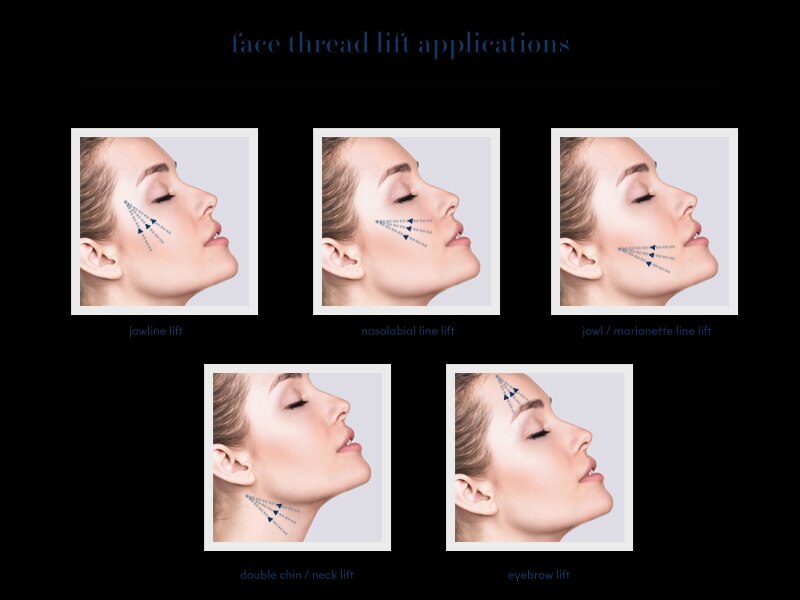 Thread Lift Srishti Skin Clinic Thane