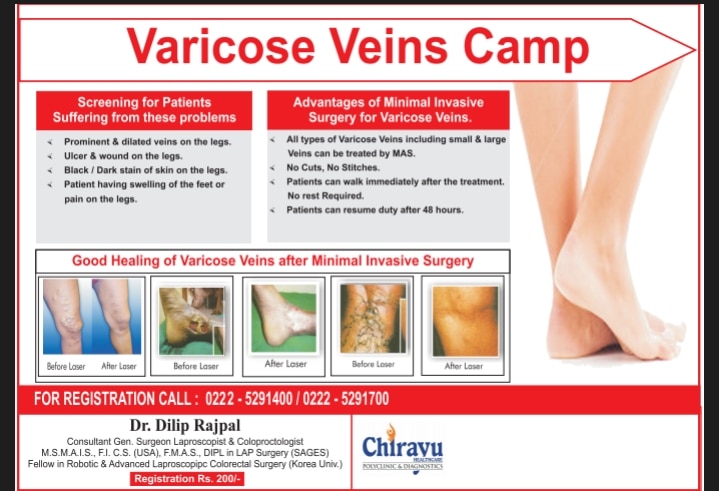 Laser varicose veins surgery
