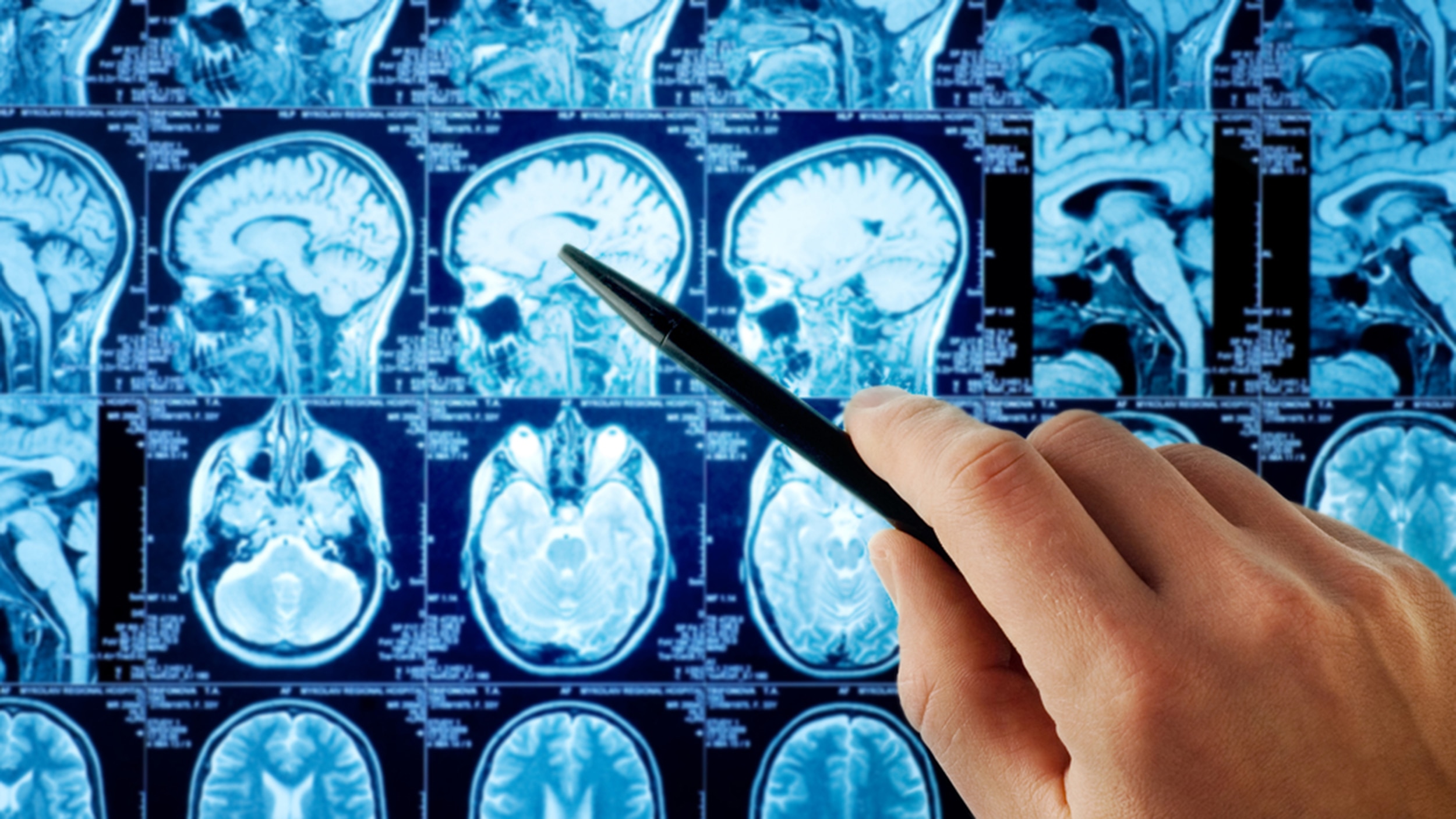 Brain Tumor surgery