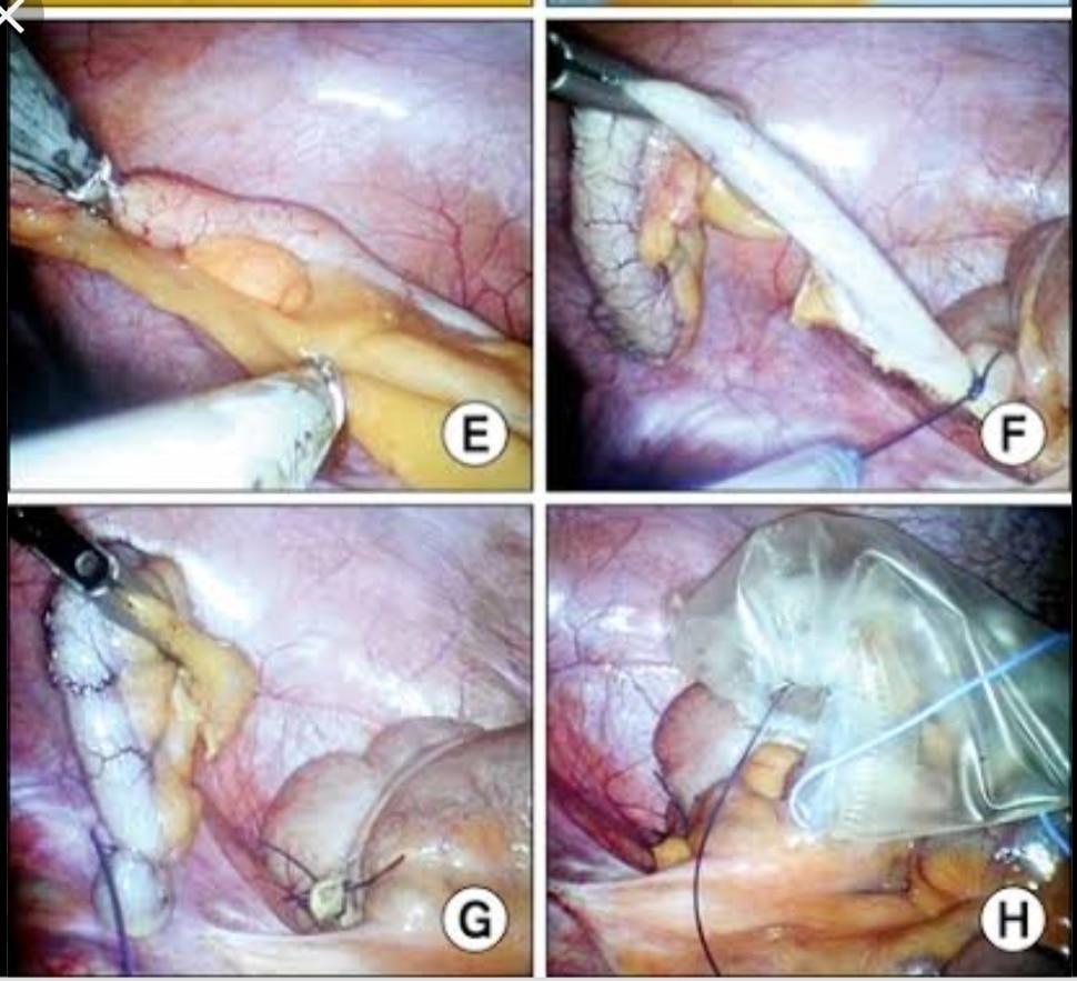 SILS/Scarless Appendectomy (Single incision laparoscopic Appendectomy)