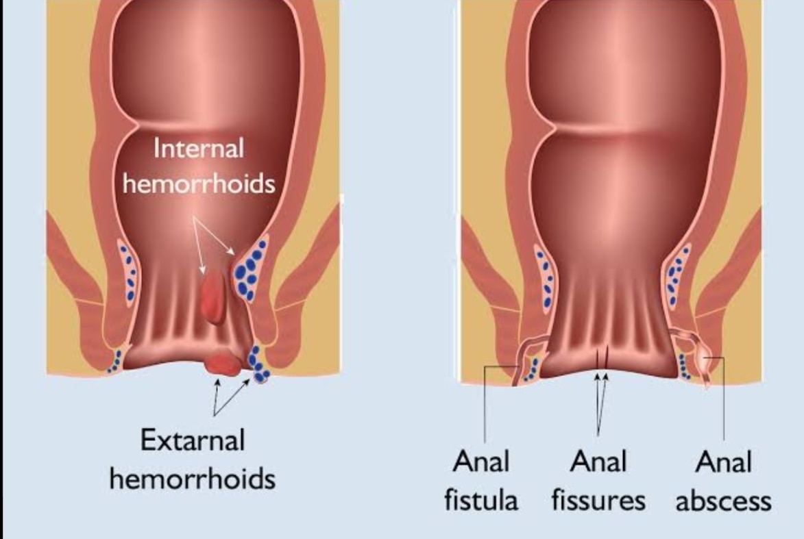 Painless piles surgery, Miph, Suture Rectopexy, laser treatment of piles