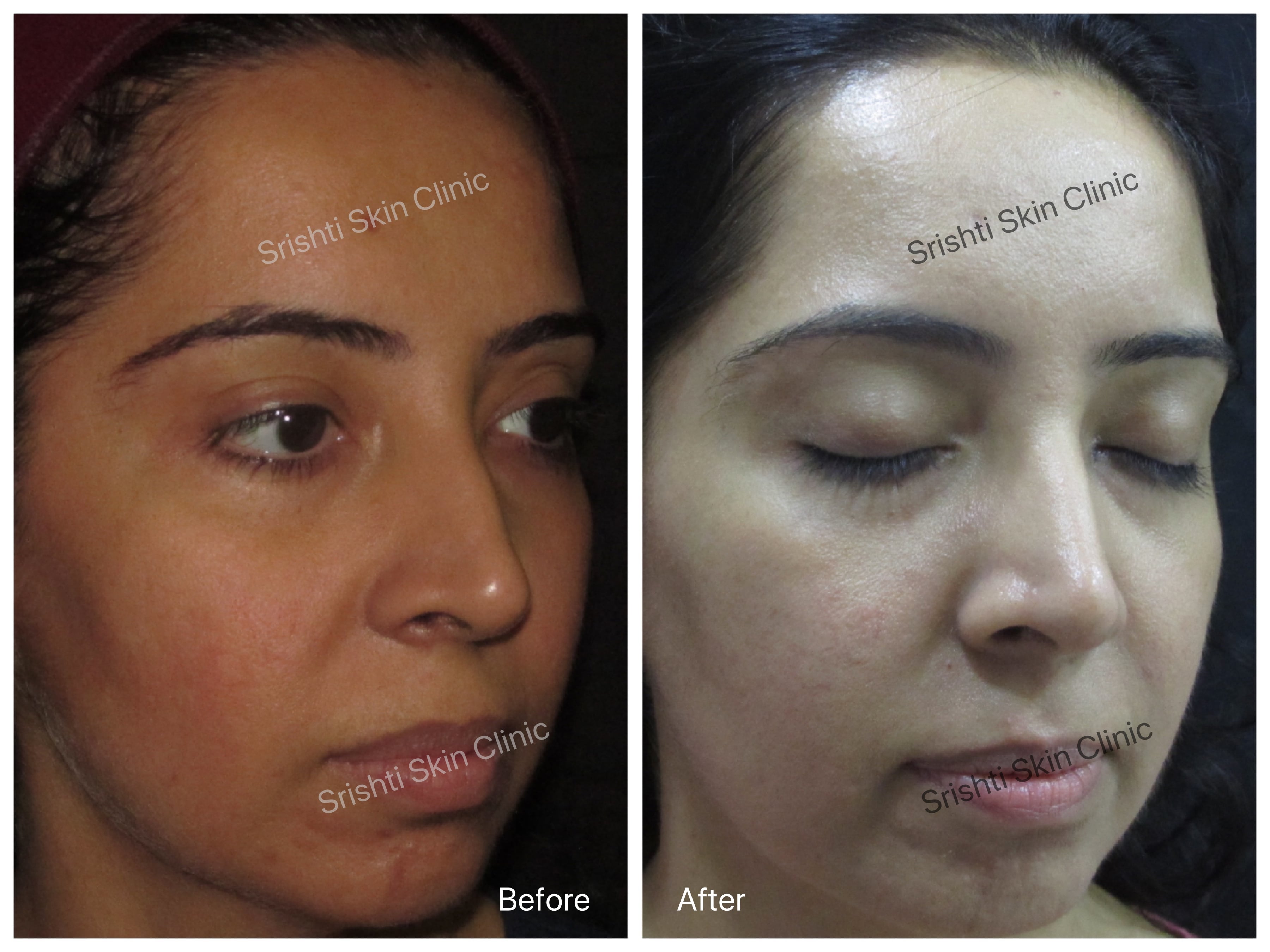 best ipl photofacial near me