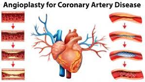 Coronary Interventions