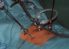 Inguinal Hernia Surgery