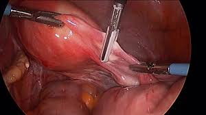 Gynecology