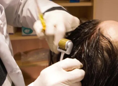 Dermaroller Therapy image 1