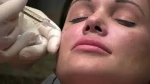 Cheek Augmentation in Indore with Fillers at Shreya’s allSkin Clinic image 1