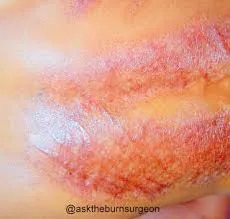 Laser Treatment for burn scars in Indore image 1
