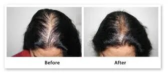 Meso Stem Cell Hair Root Therapy (MHRT) image 1