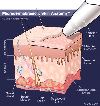 Microdermabrasion Treatment image 1