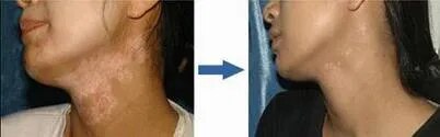 Vitiligo Treatment image 1