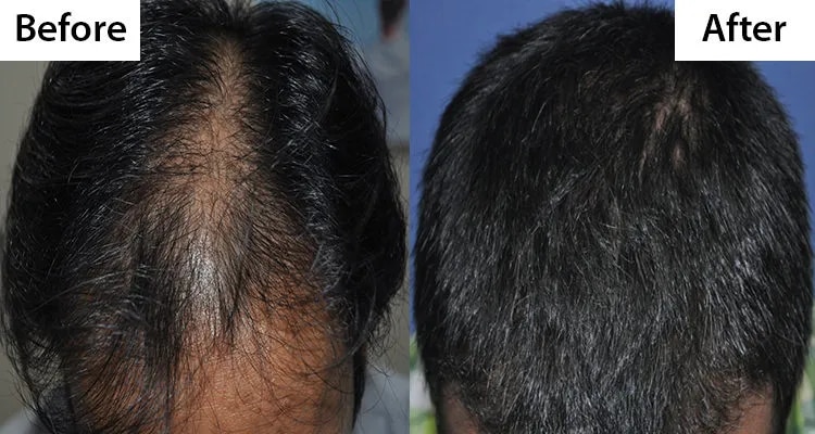 Hair Transplant image 1