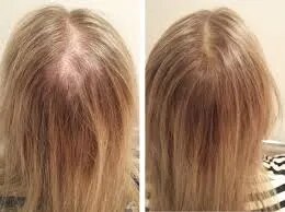 Female Hair Loss image 1